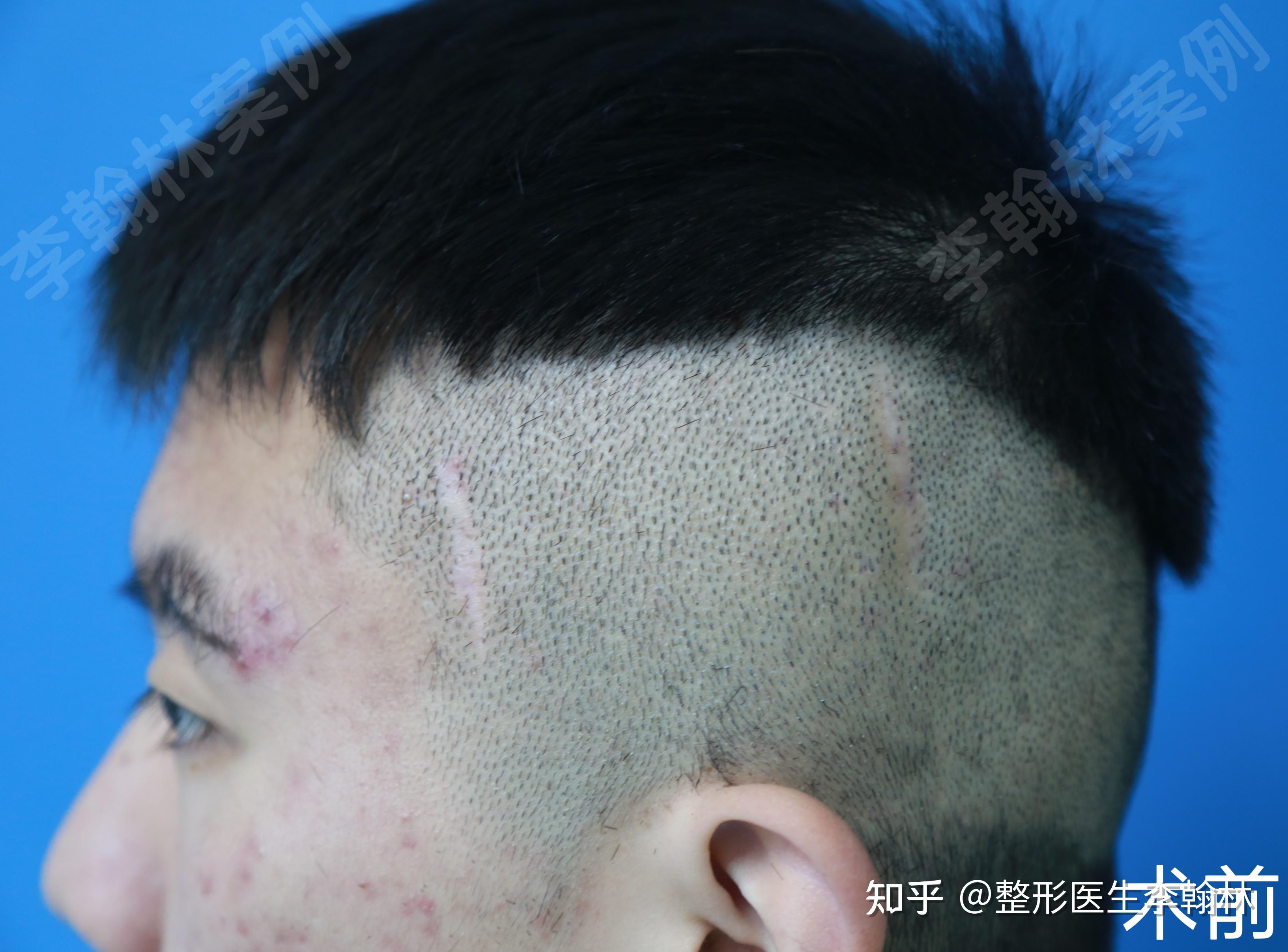 分享一个疤痕植发案例 - 知乎