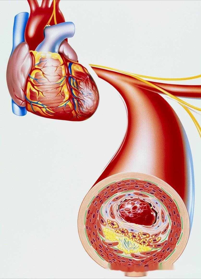 2药增加心肌供血降低血液黏度抗血栓稳斑块标本兼治冠心病