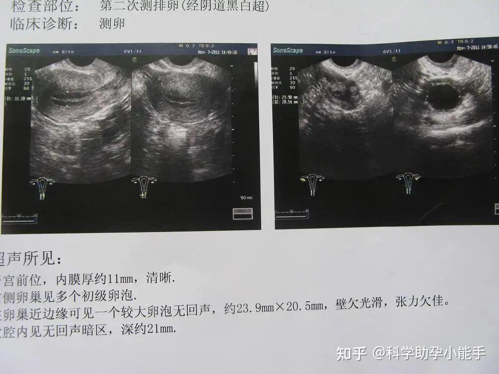 B超是怎么监测排卵的? - 知乎