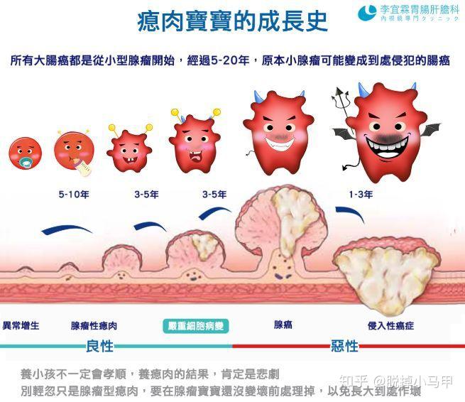 胃息肉山田分型图片图片