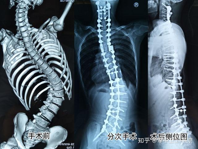 先后通过两次手术,为一位重度脊柱侧弯伴脊柱扭转患者成功实施脊柱