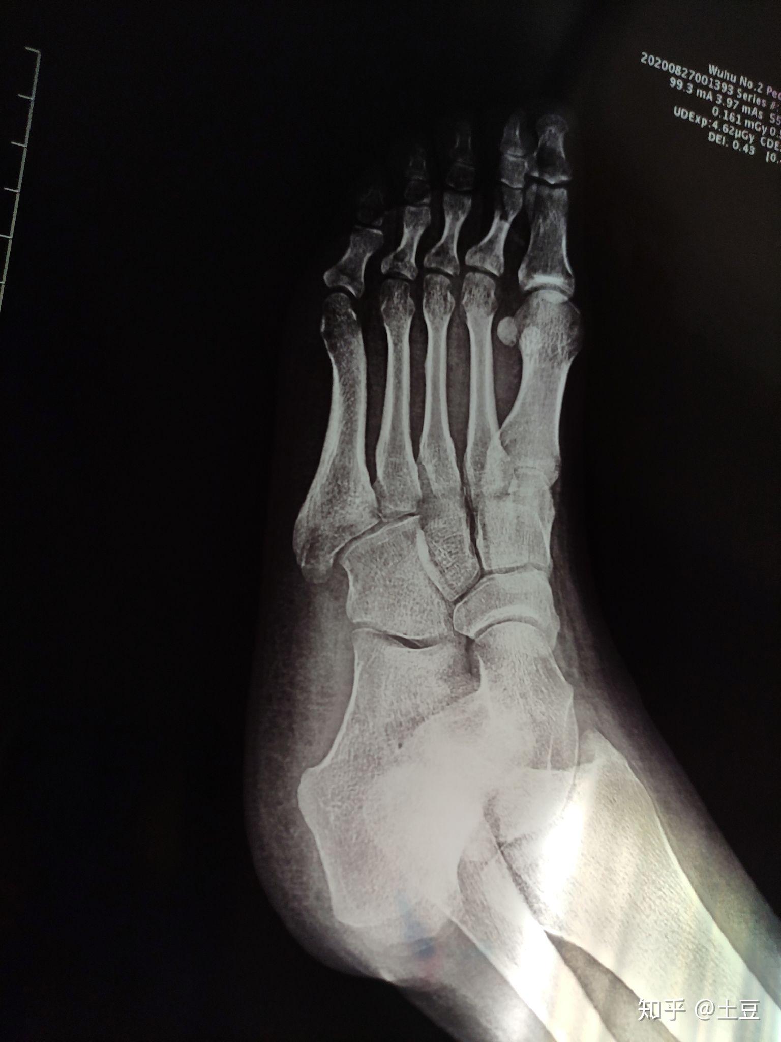 脚的第五跖骨位置图图片
