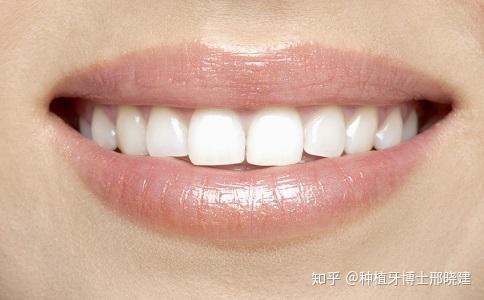 咋样让自己牙齿变白 v2-c849fff08e3415fad80ebd82b6c8fd31_r.jpg