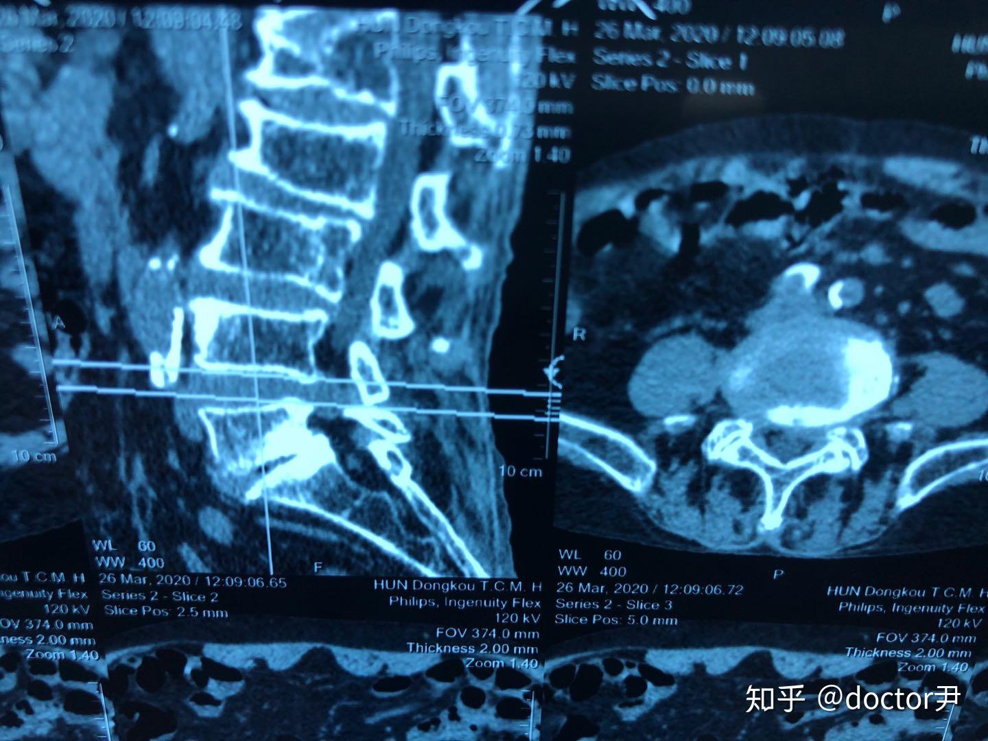正常人的脊椎ct图片-图库-五毛网