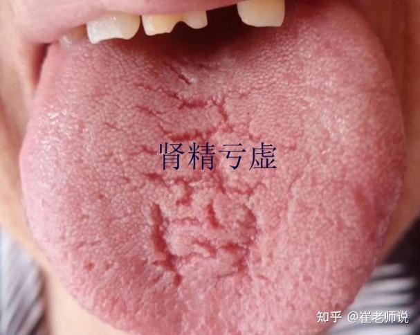舌头有裂纹就是阴虚吗?教你形象地认识四种裂纹舌,十种舌象 - 知乎
