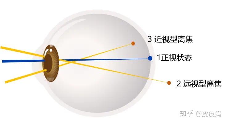 为什么要配离焦镜?离焦镜的控制原理是什么? - 知乎