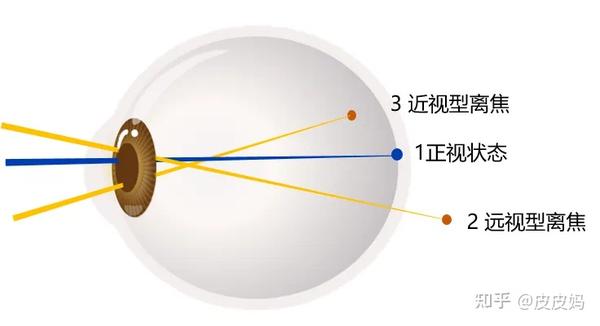 为什么要配离焦镜?离焦镜的控制原理是什么? - 知乎