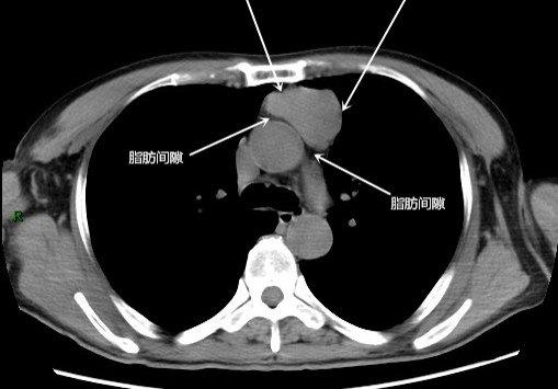 增强CT是否能判断胸腺瘤是良性还是恶性的?