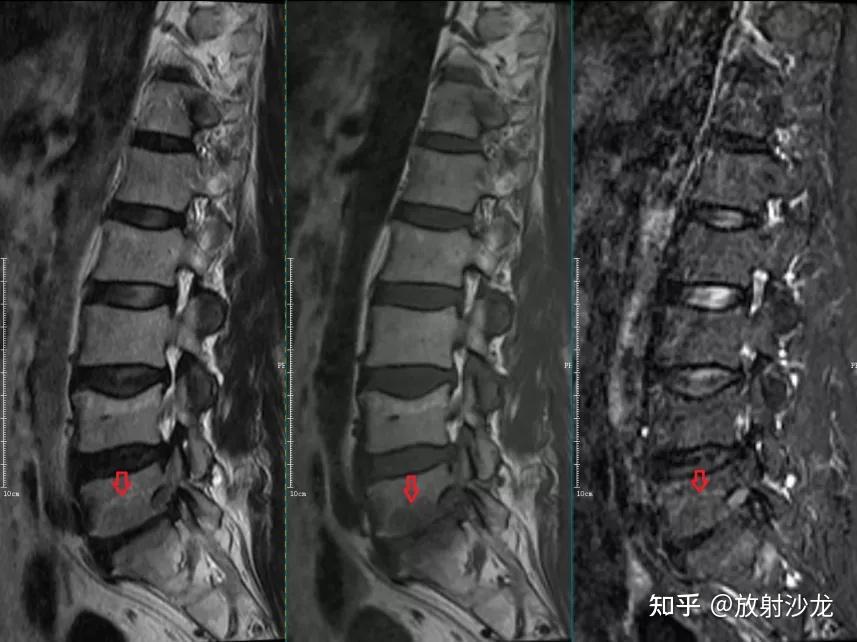 椎体终板炎 | 发生机制、分型以及 MRI 表现 - 知乎