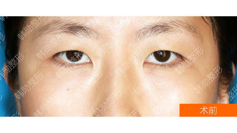 如何让眼睛变成下垂眼 v2-c895b2cbda91420773f3681bd9fe7931_1440w.jpg?source=172ae18b