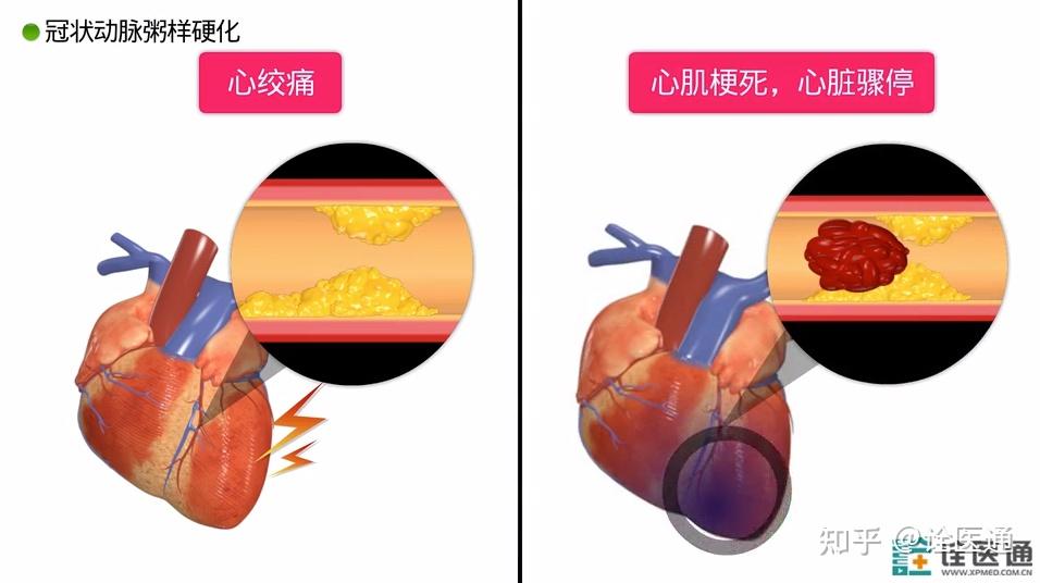 关于动脉粥样硬化这些知识你必须知道