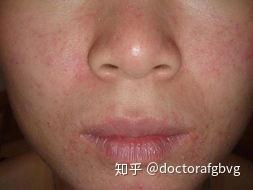 面部皮炎的注意事项 知乎