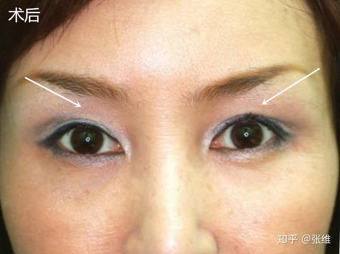 眼窝凹陷的治疗方法