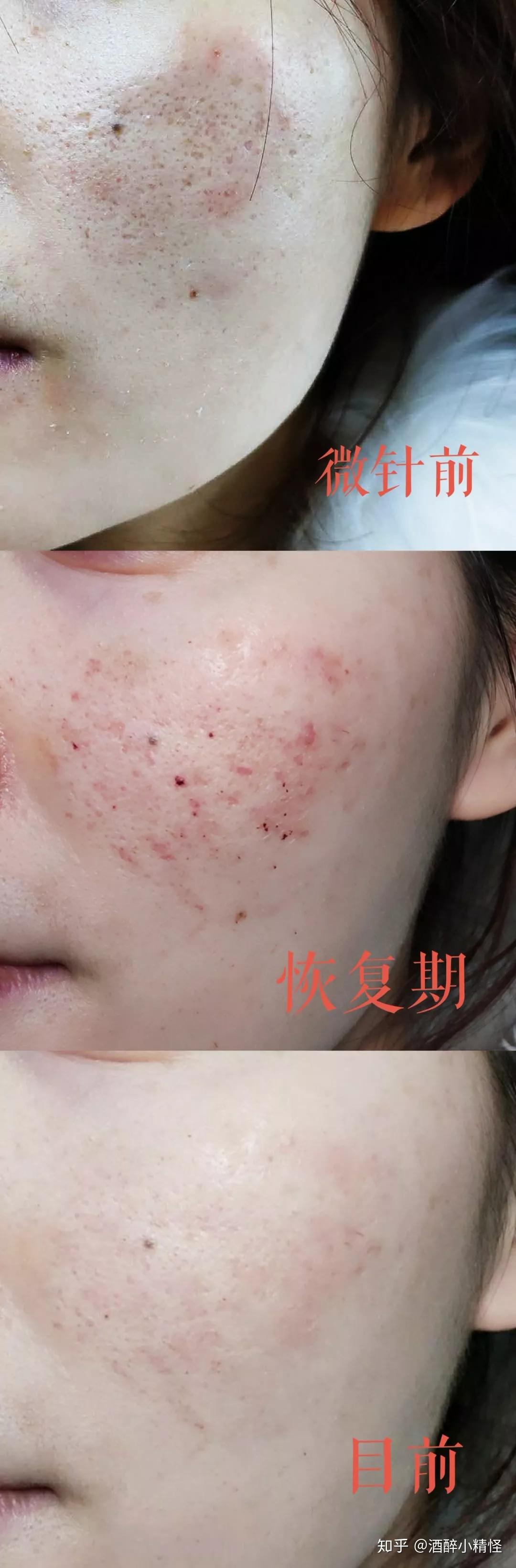 脸上的痘坑2年多了，有什么护肤品可以修复吗？_百度知道