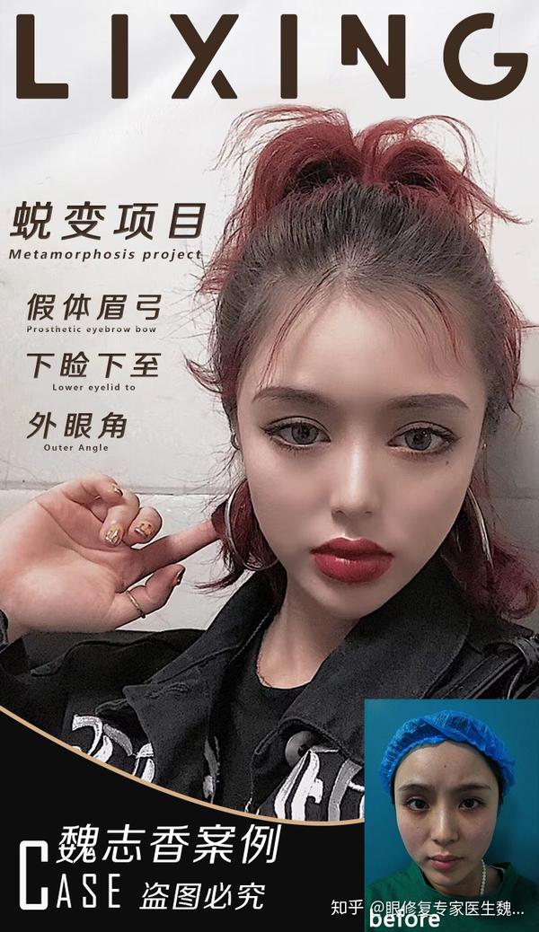 做假体眉弓前这4个问题需要搞清楚