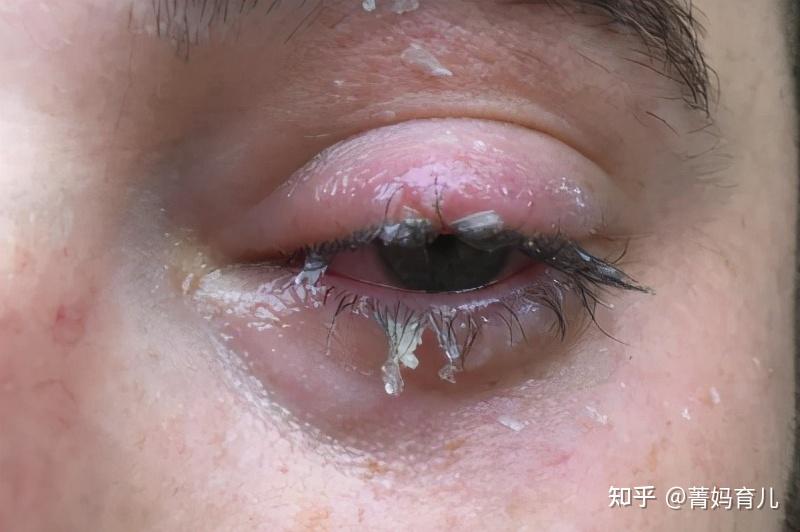 4岁宝宝咬碎体温针妈妈用4个鸡蛋救了孩子医生直点赞