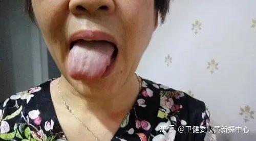 舌头一旦出现这个信号:马上去医院,千万别拖! - 知乎