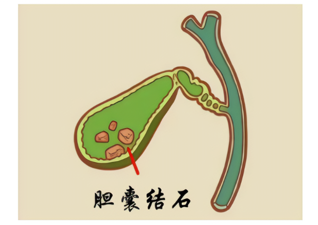 经常不吃早饭,真的会得胆结石吗? - 知乎