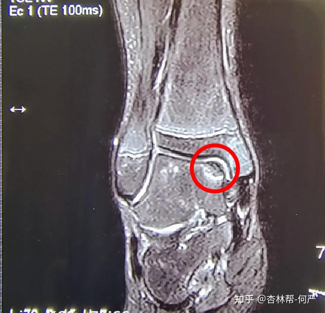 踝关节疼痛不可忽视的——“踝关节骨软骨损伤” - 微医（挂号网）