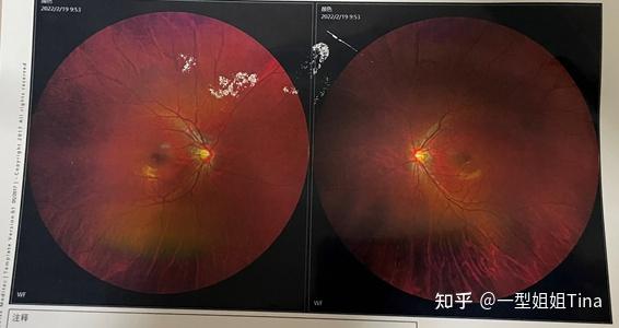 在眼科做了比较系统的检查,查了视力,裂隙灯检查,眼底拍照,眼部b超,查