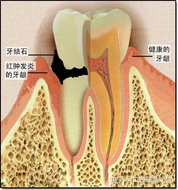 关于牙结石的10个问题