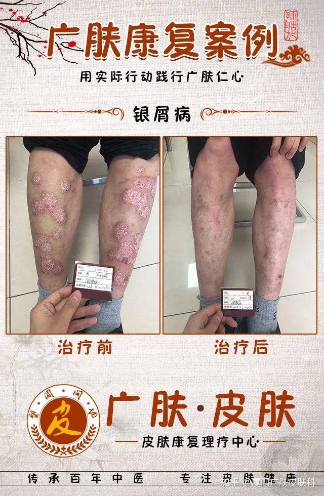 厦门治疗皮肤病医院|医生,我的这个皮肤病会传染给家人吗? - 知乎