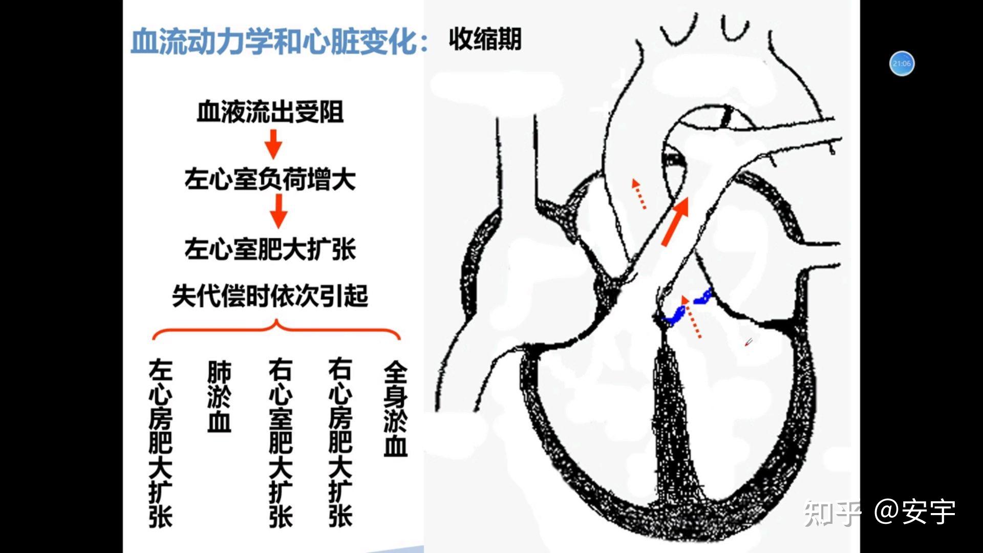 心血管系统疾病 病理 - 知乎