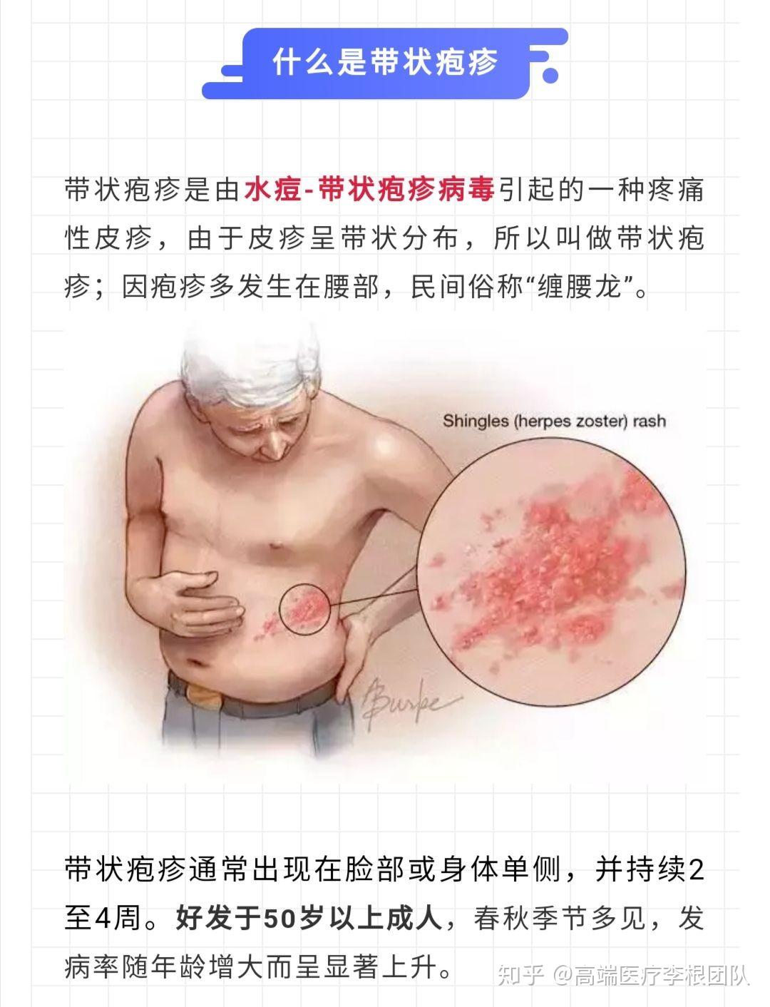 高端医疗|新世纪医院带状疱疹疫苗优先权 - 知乎
