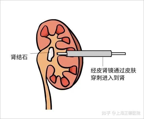 泌尿结石科普小课堂 - 知乎