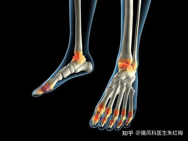 痛风患者常常在夜间突然发生关节痛,关节部位出现剧烈疼痛,水肿,红肿