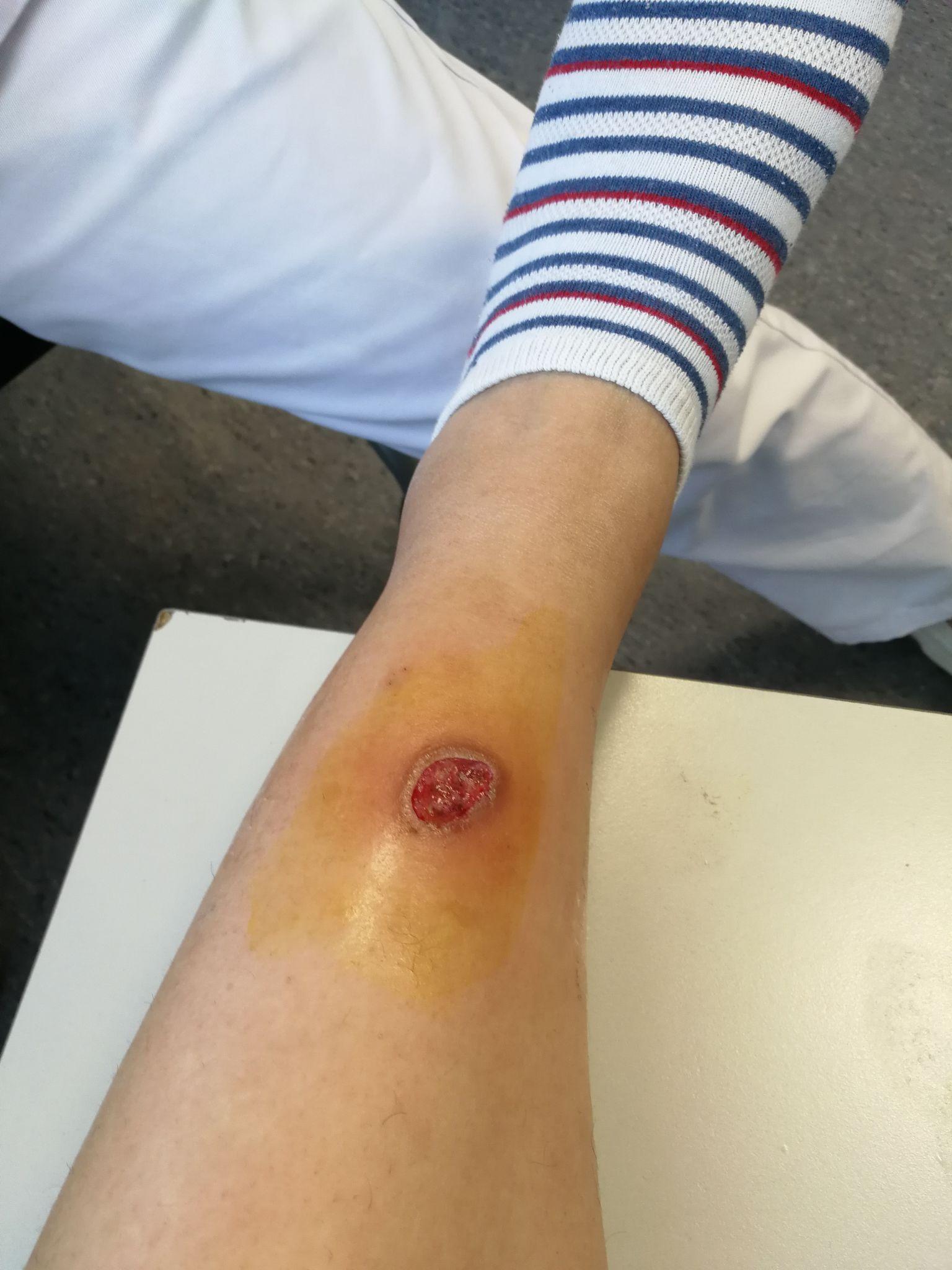 伤口化脓怎么办,会不会好不了! - 知乎