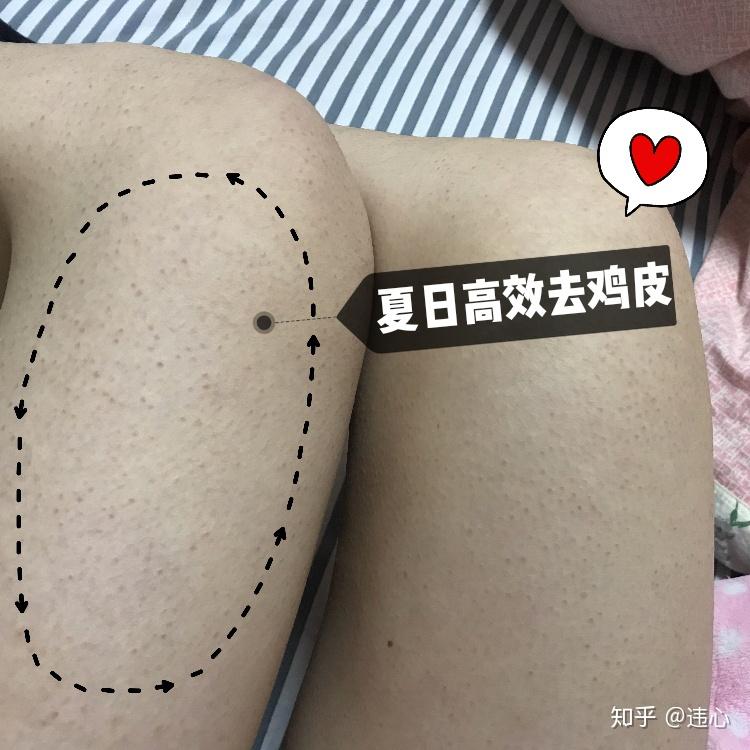 脚鸡皮肤怎么去除(脚上的鸡皮肤好难看,怎么去掉)