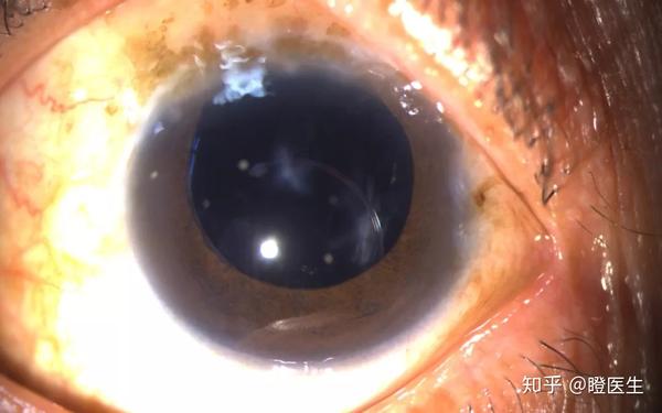 人工晶体脱位不用愁一招即修复