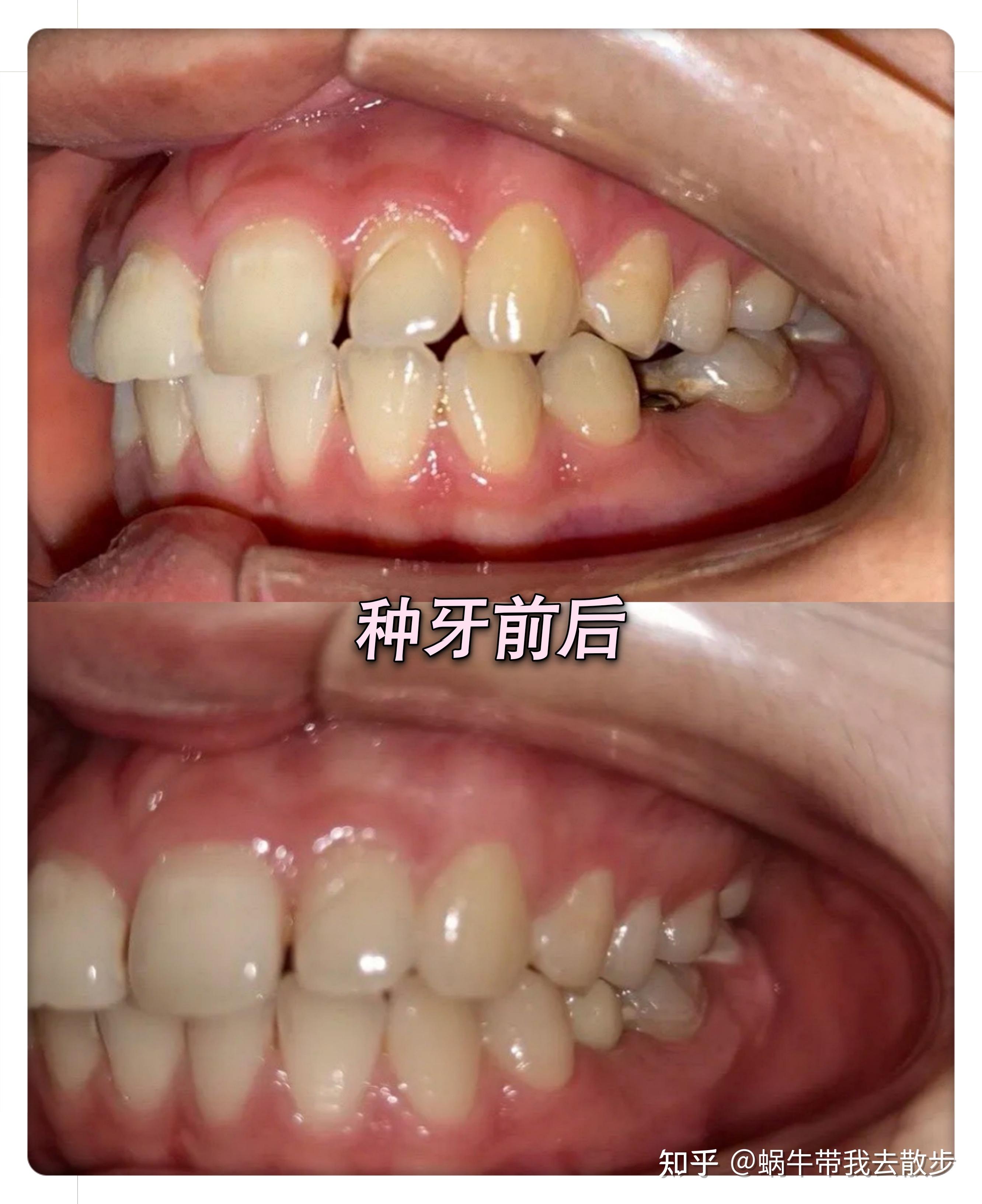 看下一张估计看不出来哈哈哈~给点不太成熟的小建议~种植牙因为个体的