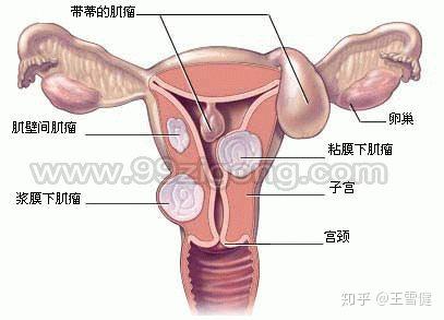 子宫肌瘤手术后应该注意些什么呢 知乎