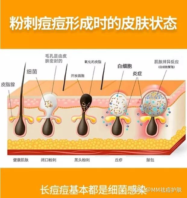 痘痘產生原因分析