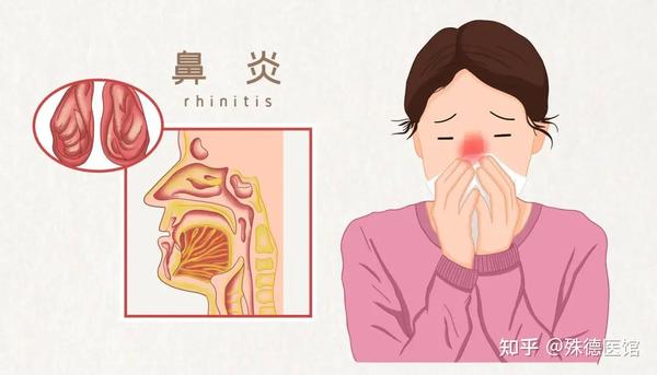 警惕!鼻炎久治不愈,小心拖成慢性病!专家教你3招有效缓解鼻塞、流涕。 - 知乎