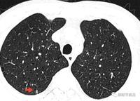 左肺下页低分化鳞状细胞癌,淋巴结转移癌确诊过程.抗癌,我们一起加油!