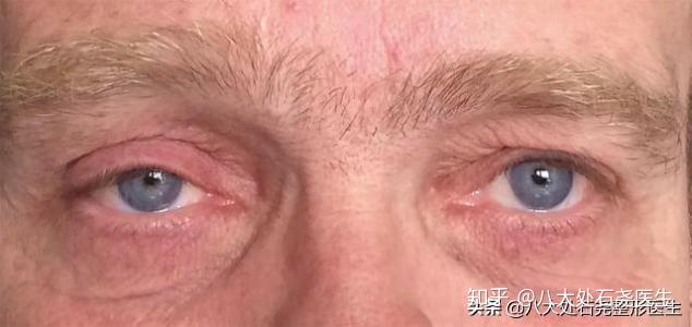 岁月催人老,一个人年龄最体现在眼睛上,如何拯救眼睛的衰老? - 知乎