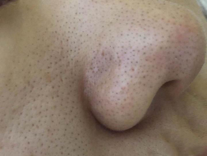 怎么去黑头呢推荐一下产品 v2-ca3967c855dca7a2403c37a3df3ace35_r.jpg