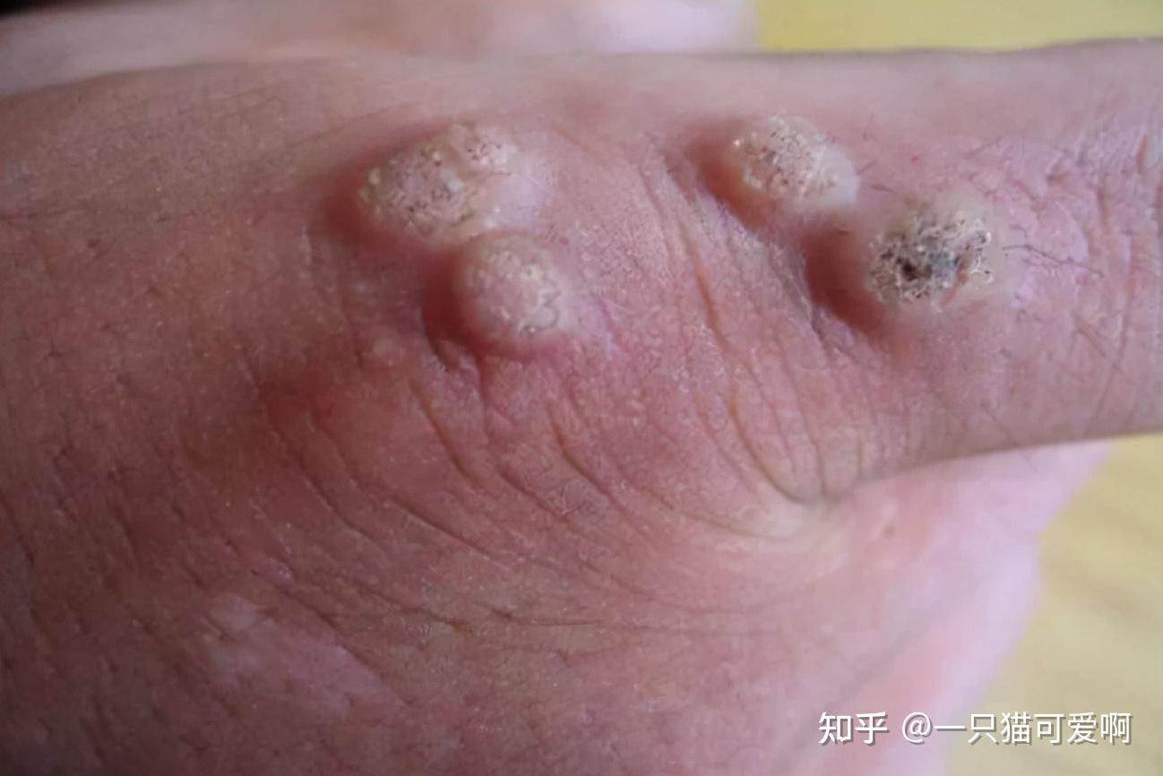 30岁女经理感染hpv满身是红点医生有2恶习要拒绝