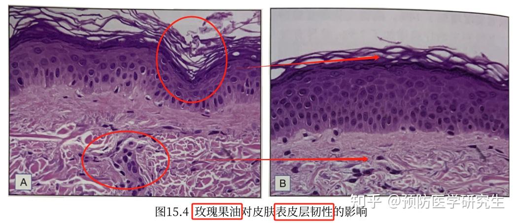 法令纹的凹陷被胶原蛋白填平后,留下的褶皱,细纹就必须靠修复弹性纤维