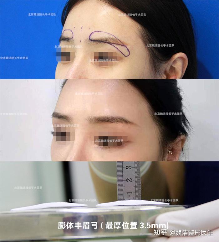 想了解假体垫眉弓知识的看官看过来 膨体眉弓十大常见问题解析 - 知乎