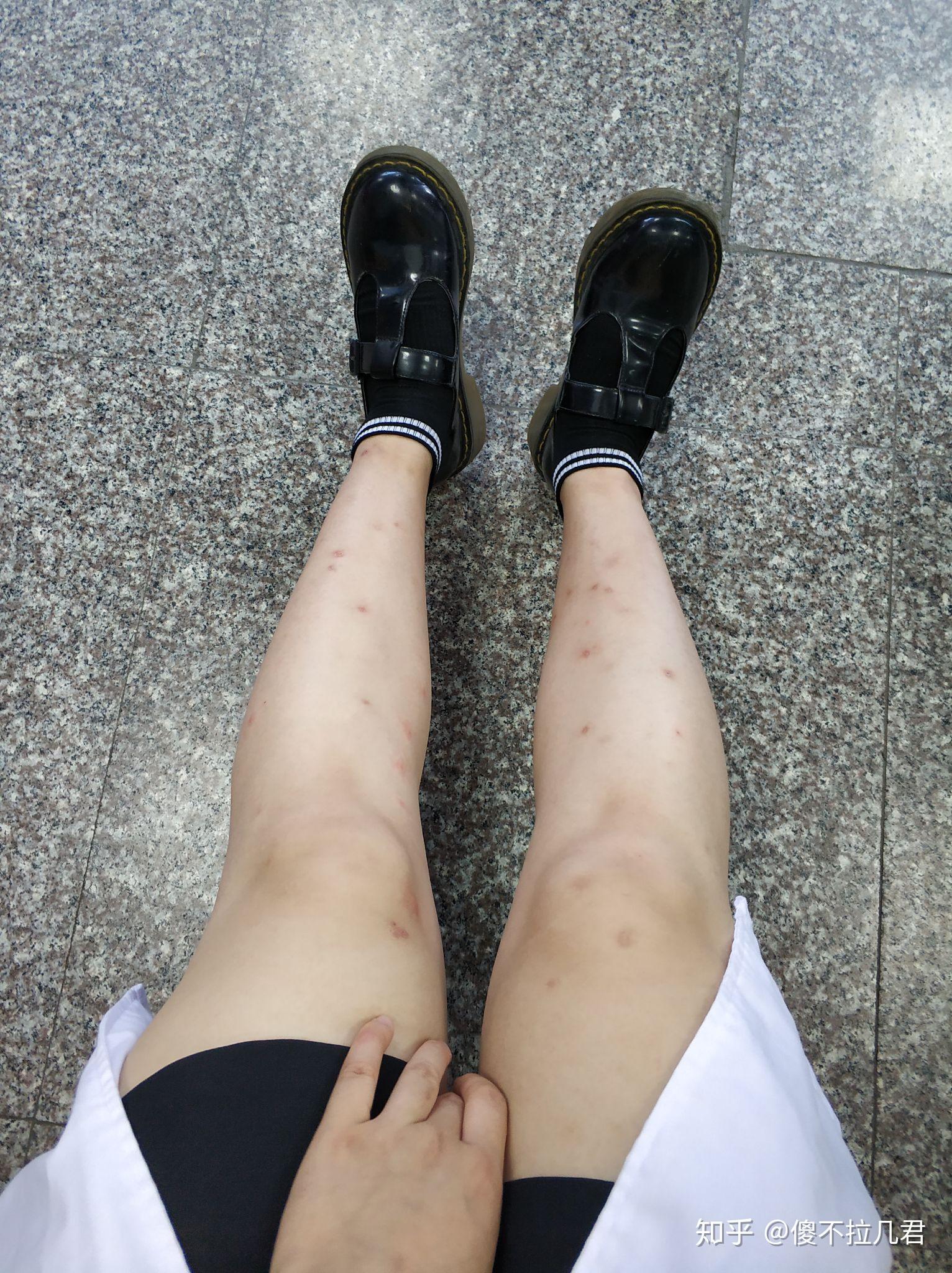 你被蚊子咬了会干嘛