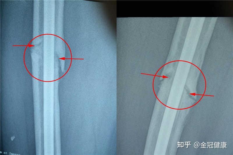 骨不连患者病例介绍附骨不连两年以上会怎样