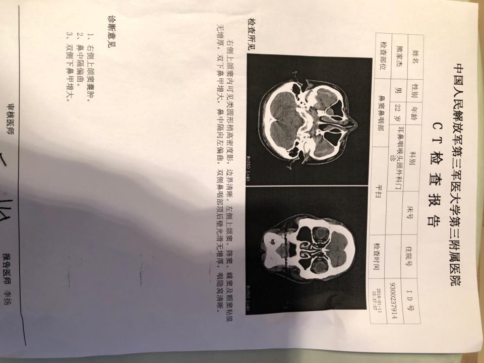 上个月刚做过鼻中隔偏曲手术,手术需要两个月
