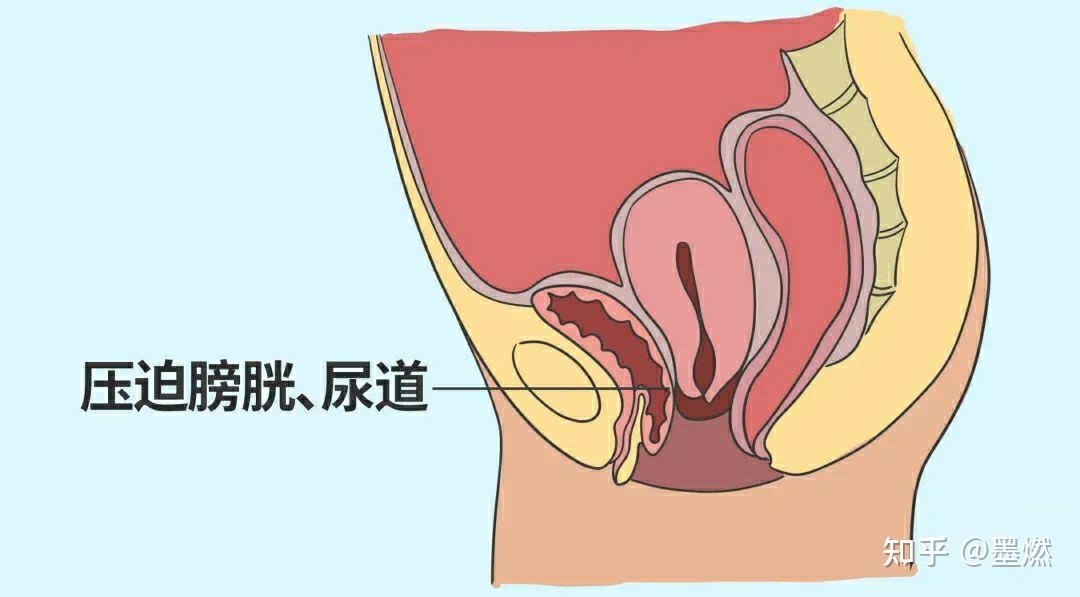 此时,将面临尿频,尿急,排尿困难,经常性尿道感染等问题.