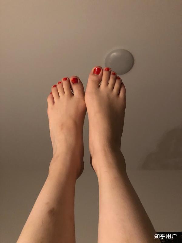 女生脚趾拇外翻是什么样体验?