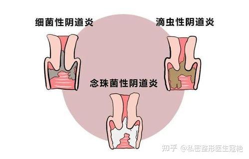 羞羞时闻到怪怪的味道是宫颈癌吗