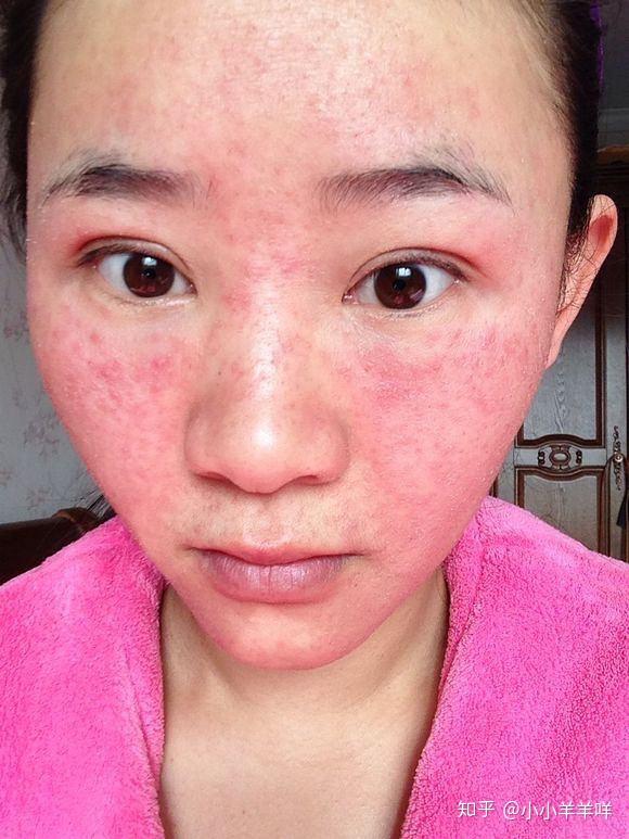 有红血丝敏感肌这个可以用吗这个牌子你们见过吗导购推荐的有点怕再长